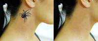 Best Laser Tattoo Removal in Melbourne image 2